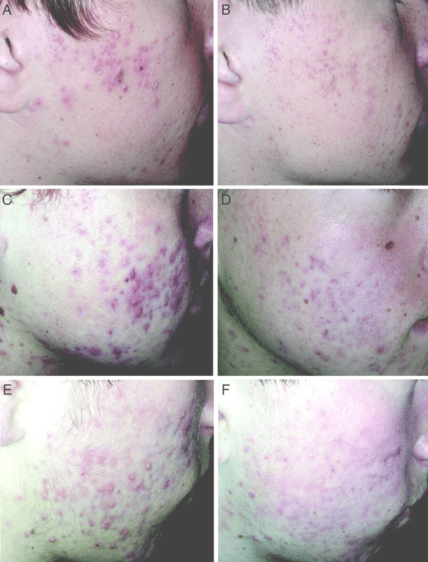 Keto vs. High Glycemic Load Diet for Acne