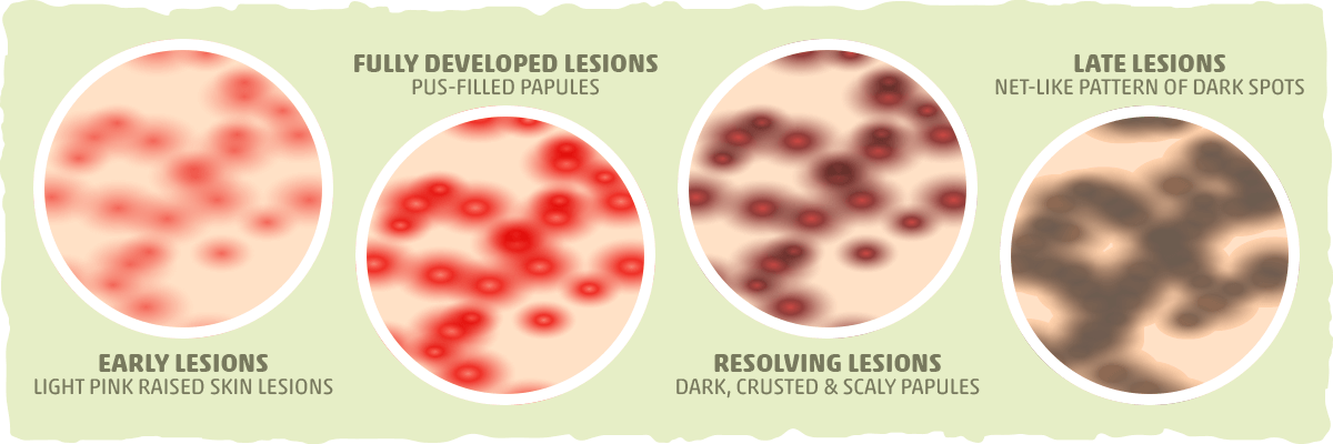 What Does Keto Rash Look Like?